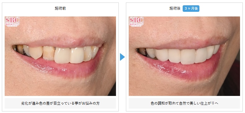 セラミック治療の術前と術後""